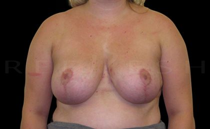 Breast Lift with Implants Before & After Patient #6917