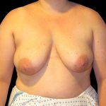 Breast Lift with Implants Before & After Patient #6917