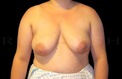 Breast Lift with Implants Before & After Patient #6917