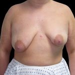 Breast Lift with Implants Before & After Patient #6919