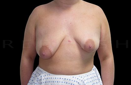 Breast Lift with Implants Before & After Patient #6919