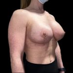 Breast Lift with Implants Before & After Patient #6920