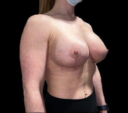 Breast Lift with Implants Before & After Patient #6920