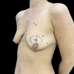 Breast Lift with Implants Before & After Patient #6921