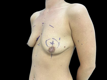 Breast Lift with Implants Before & After Patient #6921