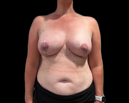 Breast Lift with Implants Before & After Patient #6922