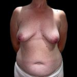 Breast Lift with Implants Before & After Patient #6922