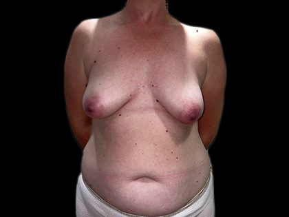 Breast Lift with Implants Before & After Patient #6922