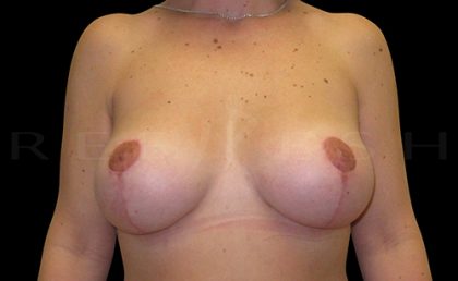Breast Lift with Implants Before & After Patient #6909