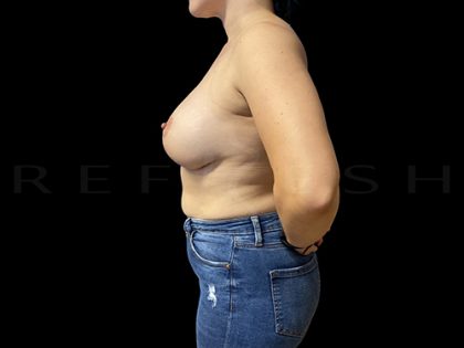 Breast Lift with Implants Before & After Patient #6912