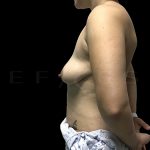 Breast Lift with Implants Before & After Patient #6912