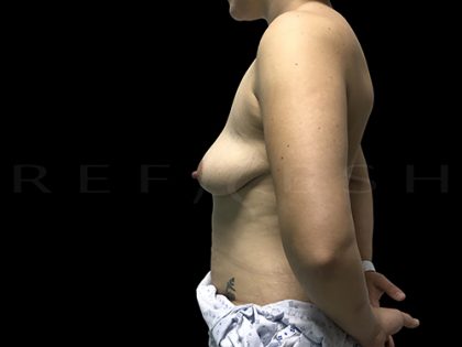 Breast Lift with Implants Before & After Patient #6912