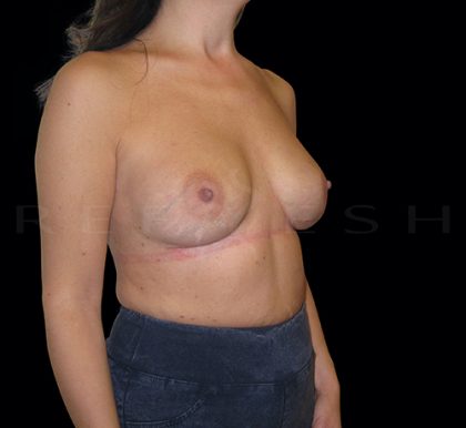 Breast Implant Exchange Before & After Patient #6939