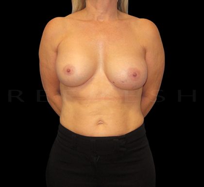 Breast Implant Exchange Before & After Patient #6940