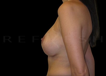 Breast Implant Exchange with Breast Lift Before & After Patient #6961