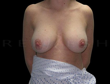 Breast Implant Exchange with Breast Lift Before & After Patient #6962