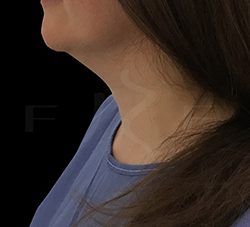 VASER to Face Before & After Patient #6976