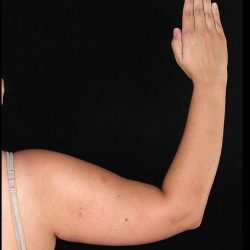 Bodytite Before & After Patient #7245
