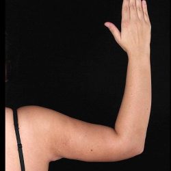 Bodytite Before & After Patient #7245