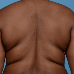 Bodytite Before & After Patient #7246