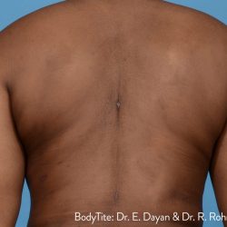 Bodytite Before & After Patient #7246