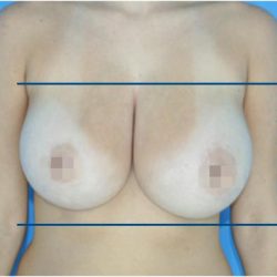Bodytite Before & After Patient #7247