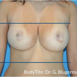 Bodytite Before & After Patient #7247