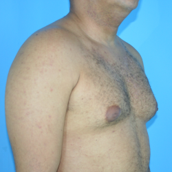 Bodytite Before & After Patient #7248