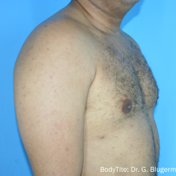 Bodytite Before & After Patient #7248