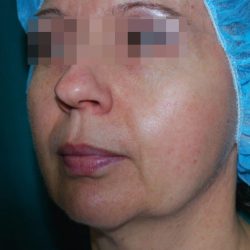Facetite Before & After Patient #7249