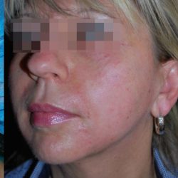 Facetite Before & After Patient #7249