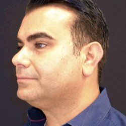 Facetite Before & After Patient #7251