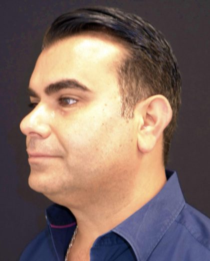 Facetite Before & After Patient #7251