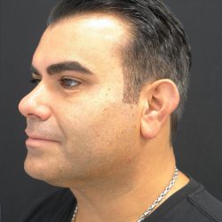 Facetite Before & After Patient #7251