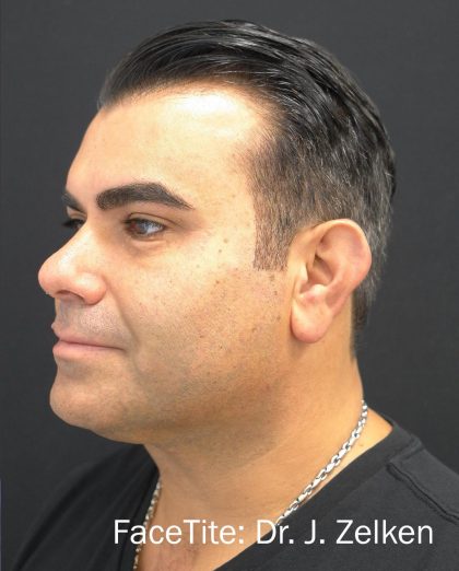 Facetite Before & After Patient #7251