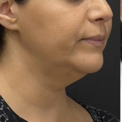 Facetite Before & After Patient #7253