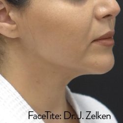 Facetite Before & After Patient #7253
