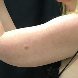 Bodytite Before & After Patient #7294