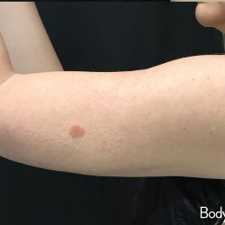Bodytite Before & After Patient #7294