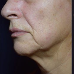 Facetite Before & After Patient #7254