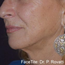 Facetite Before & After Patient #7254