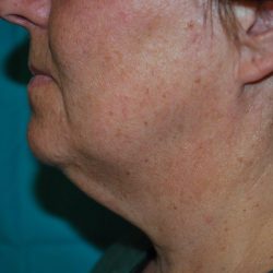 Facetite Before & After Patient #7255