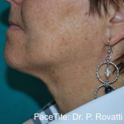 Facetite Before & After Patient #7255