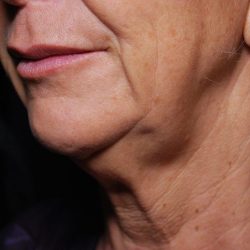 Facetite Before & After Patient #7256