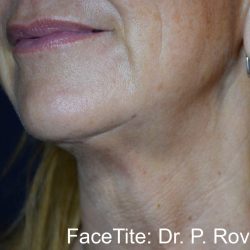 Facetite Before & After Patient #7256