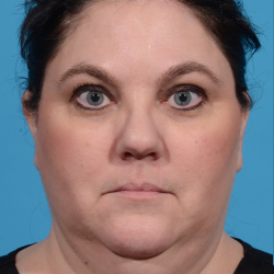 Facetite Before & After Patient #7257