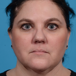Facetite Before & After Patient #7257