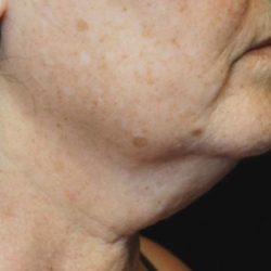 Facetite Before & After Patient #7259