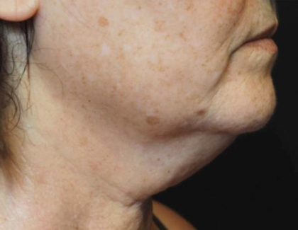 Facetite Before & After Patient #7259