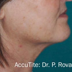 Facetite Before & After Patient #7259